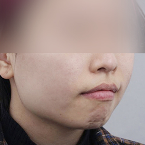 痘痘/疤痕護理 施術後行動端圖片 1
