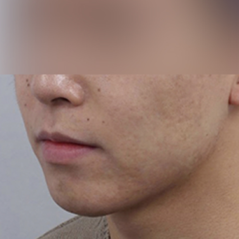 痘痘/疤痕護理 施術後行動端圖片 2