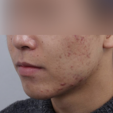 痘痘/疤痕護理 施術前行動端圖片 2