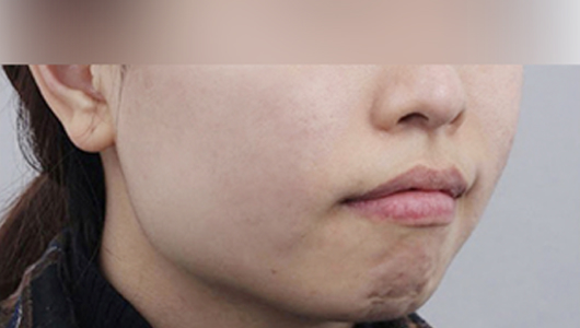 痘痘/疤痕護理 施術後圖片 1