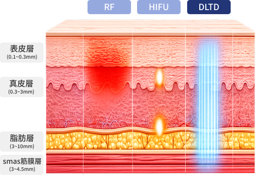 RF, HIFU, DLTD 肌膚層作用靶點對比圖
