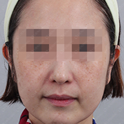 色素美白 施術前 行動端圖片 1