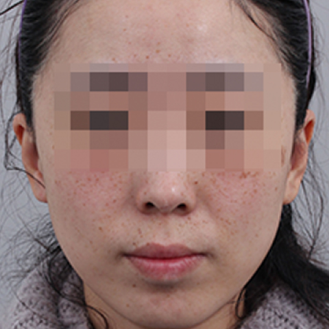 色素美白 施術前 行動端圖片 2